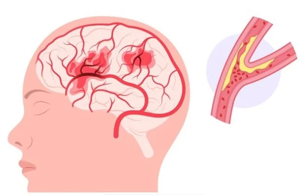 What is a Stroke?